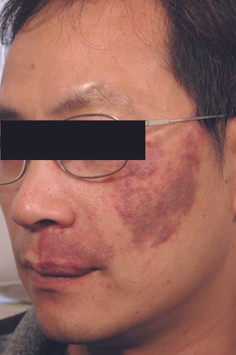 Port Wine Birthmark Removal