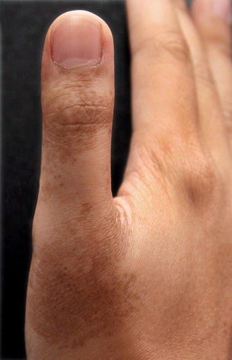 Birthmark Laser