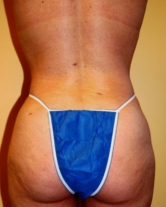Body Jet (water assisted) liposuction