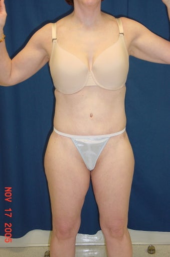 Bodylift