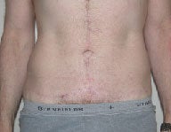 Dermolipectomy 