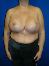 Surgery After Massive Weight Loss