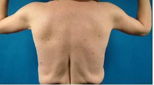 Arm Lift and Upper Body Lift
