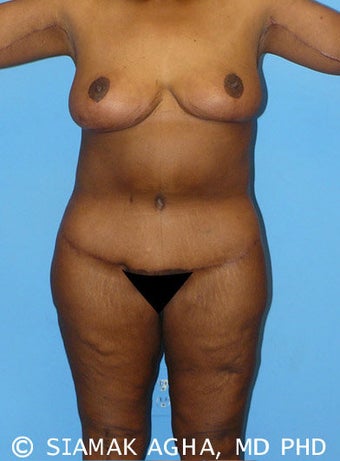 High-Definition™ Total Body Lift