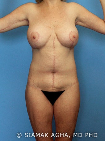 High-Definition™ Total Body Lift