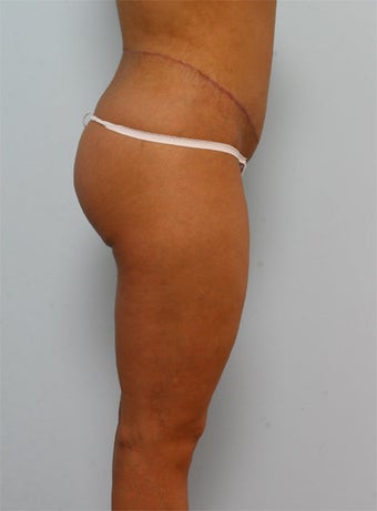 Body Lift