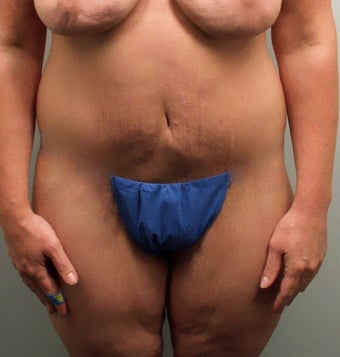 Body Lift