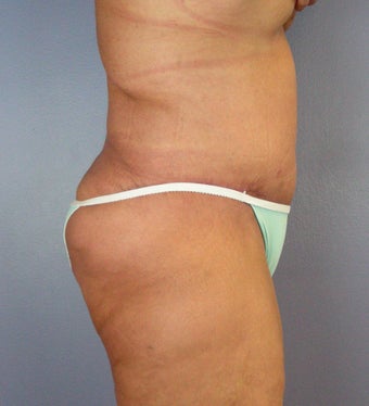 Body Lift