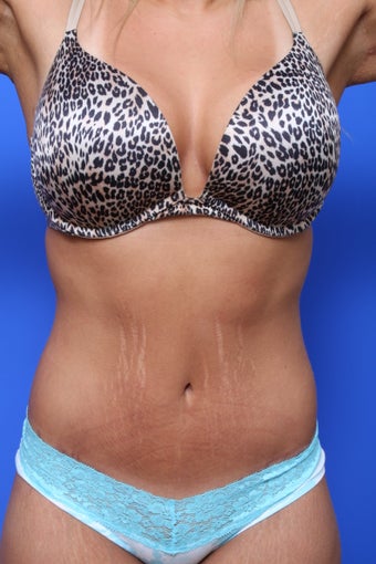 Body Lift