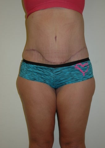 29 year old female treated for excess skin and weight.