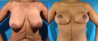 Breast and Body Lift