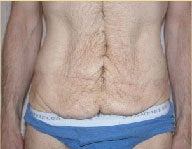 Dermolipectomy 