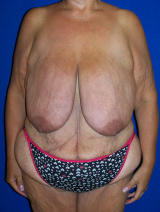 Surgery After Massive Weight Loss