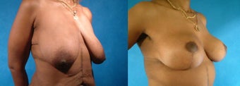 Breast and Body Lift
