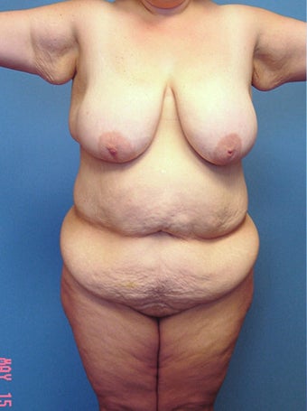 High-Definition™ Total Body Lift