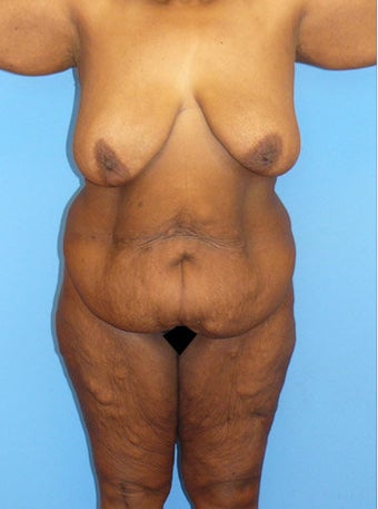 High-Definition™ Total Body Lift