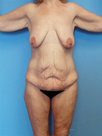 High-Definition™ Total Body Lift