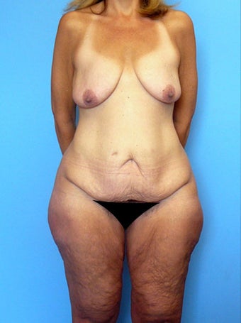 High-Definition™ Total Body Lift
