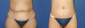 Before and after body lift