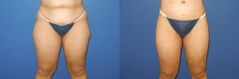Before and after full body lift surgery