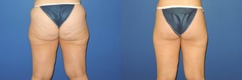 Before and after body lift, rear view