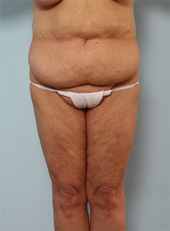 Body Lift