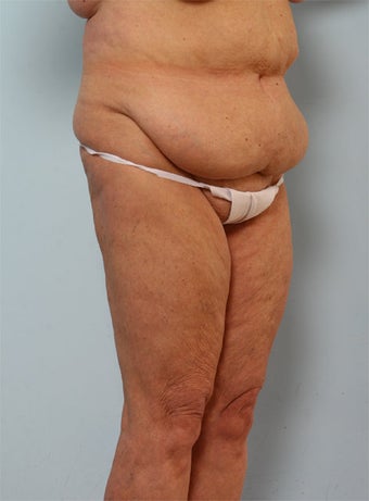 Body Lift