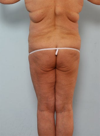 Body Lift