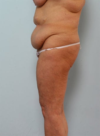 Body Lift