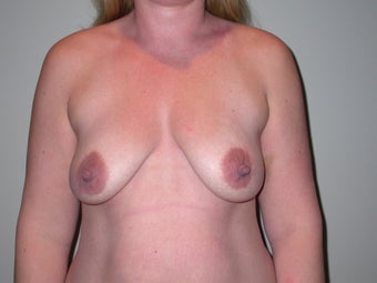 Breast lift, abdominoplasty, liposuction