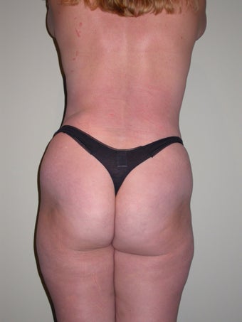 Breast lift, abdominoplasty, liposuction