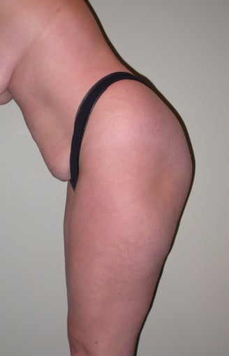 Breast lift, abdominoplasty, liposuction