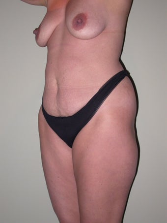 Breast lift, abdominoplasty, liposuction