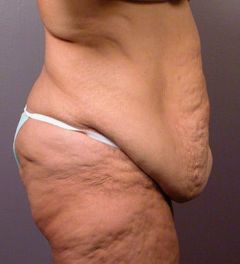 Body Lift