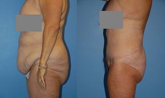 Body Lift