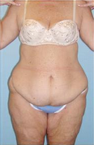 Body Lift