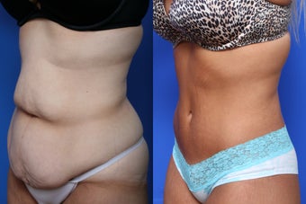 Body Lift