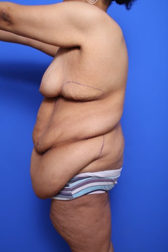 Body Lift with Panniculectomy