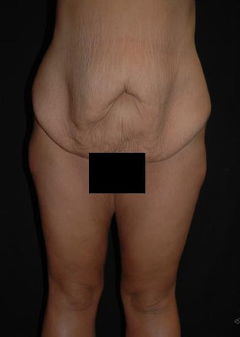 29 year old female treated for excess skin and weight.