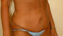 Body Lift