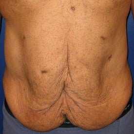 Body Lift