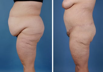 Bilateral Lower Body Lift and Liposuction
