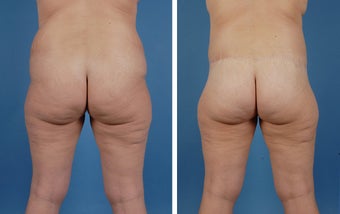 Lower Body Lift and Liposuction of Lateral Thighs
