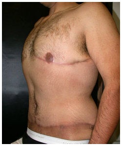 Body Lift and Male Breast Reduction