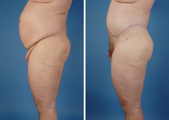 Upper & Lower Body Lift