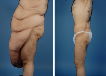 Body Lift