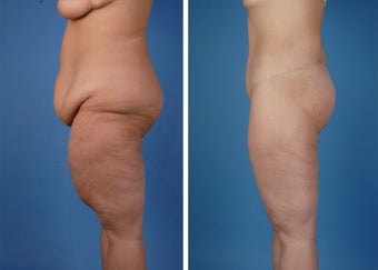Lower Body Lift and Thighplasty