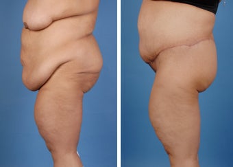 Lower Body Lift and Extended Tummy Tuck