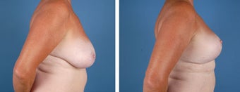 Breast Lift