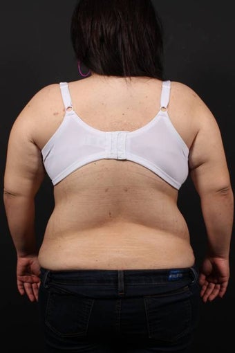 Bra Line Back Lift